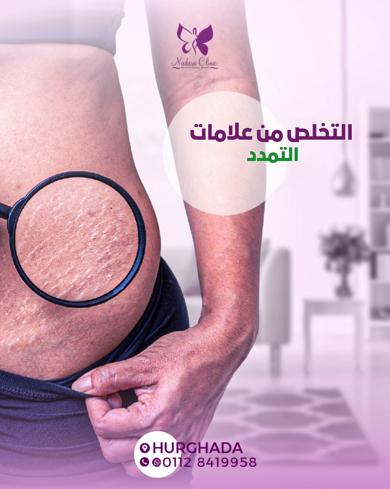 التخلص من علامات التمدد في الغردقة